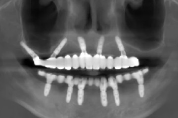 种植牙的五大危害，损伤神经/上颌窦穿通/出血/伤及邻牙/出现异物