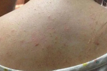 螨虫咬了是什么样子图怎么判断，会有瘙痒的丘疹性荨麻疹
