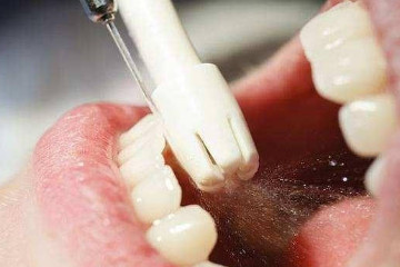 洗牙的好处和坏处注意事项，预防口腔疾病/牙釉质损伤