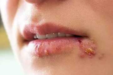 嘴上疱疹和上火水泡的区别图，症状有明显的不同