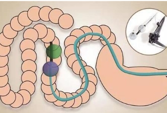 肠镜为什么尽量不要做，非常疼(不过现在可以无痛肠镜了)