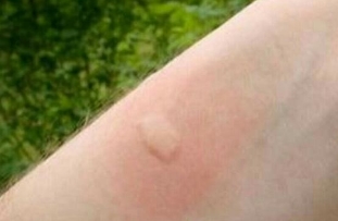 被蚊子咬了怎么消肿止痒最快，用冰块冷敷很快就能消肿止痒